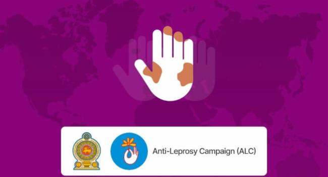 1,250 leprosy cases reported so far this year